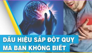 dấu hiệu đột quỵ