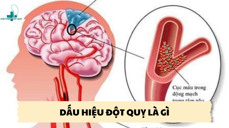 dấu hiệu đột quỵ là gì